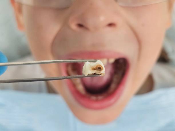 Best Chipped Tooth Repair Near Me  in Indiantown, FL